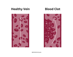 Health Vein vs Blood Clot