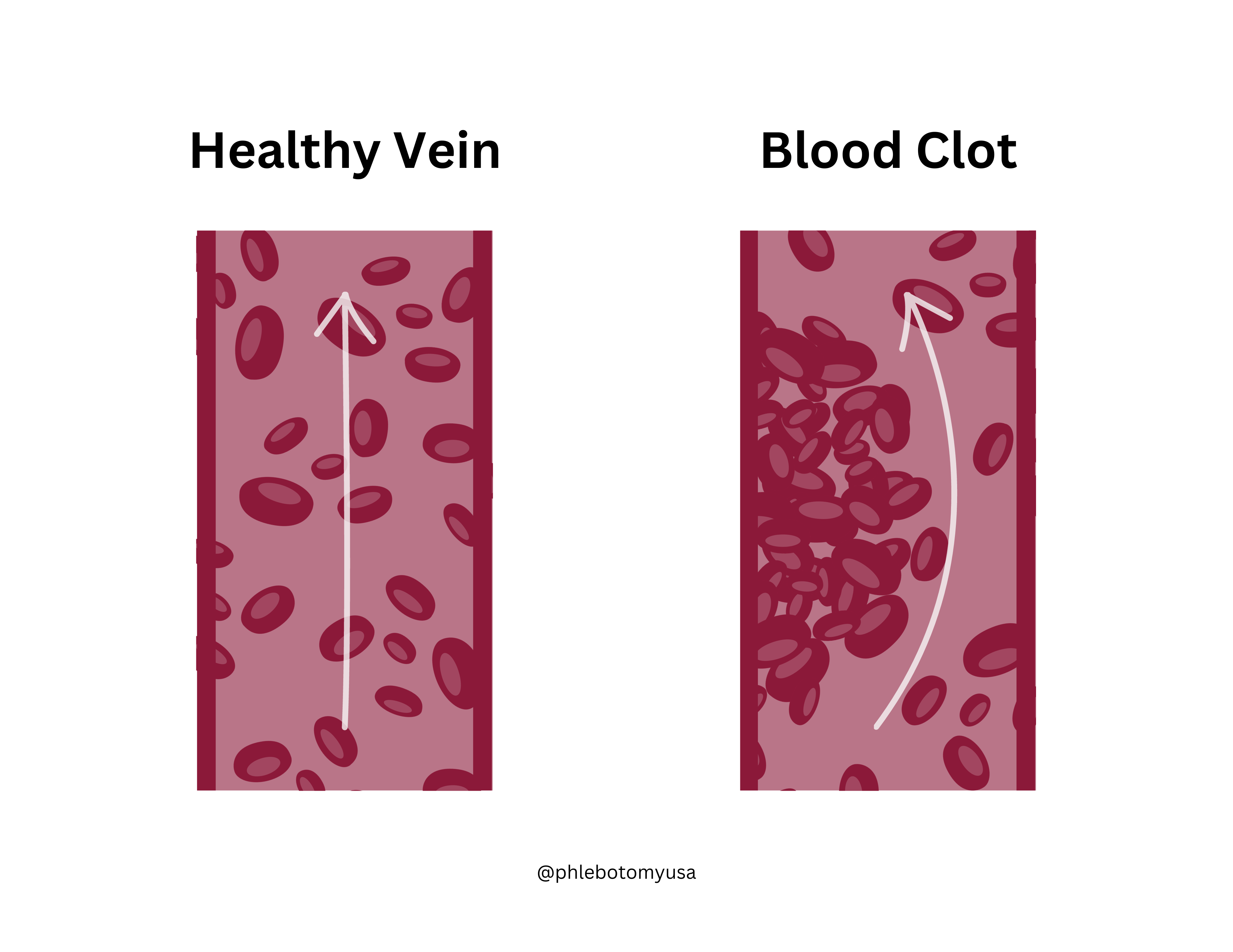 Debunking 8 Myths About Blood Clots