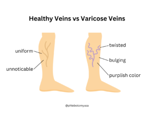 Varicose Veins vs Healthy Veins