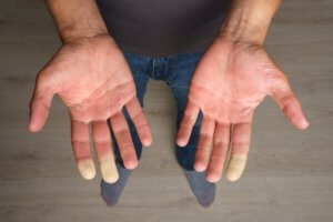 raynaud's in fingers